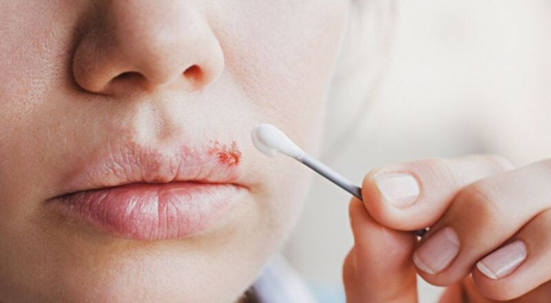 Điều trị herpes môi bằng thuốc kháng virus 