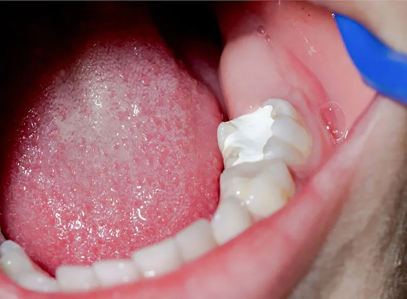 Biến chứng nếu không điều trị sớm