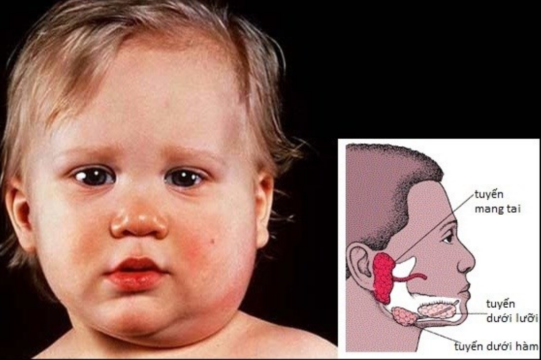 Các đối tượng nguy cơ mắc bệnh quai bị