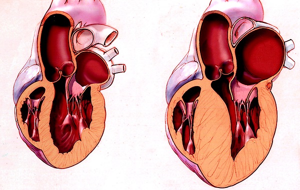 Hình ảnh cơ tim dày lên (bên phải) trong bệnh cơ tim phì đại