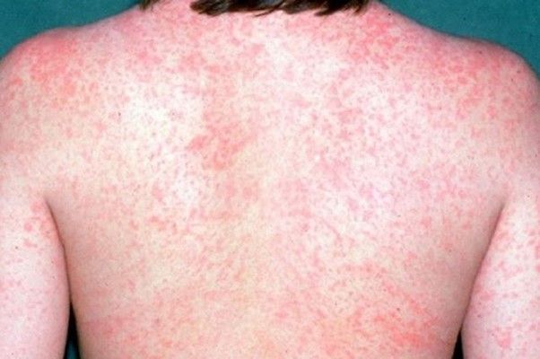 Hình ảnh minh họa tình trạng nổi phát ban với các mảng đỏ trên da