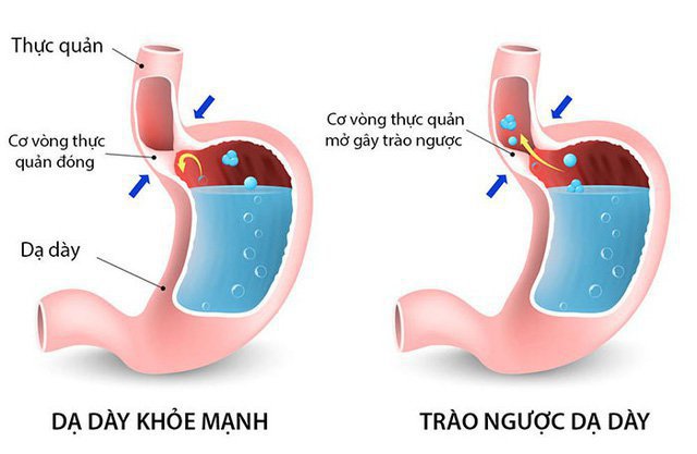 Acid dạ dày tăng cao kích thích cơ vòng thực quản mở, dịch vị dạ dày trào ngược lên thực quản