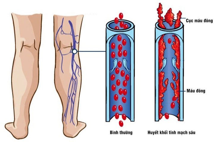 Hình ảnh huyết khối tĩnh mạch sâu