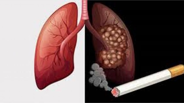 Nói không với hút thuốc lá để bảo vệ phổi và ngăn ngừa tình trạng ho ra máu