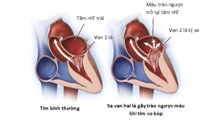 Hở van hai lá là gì? 