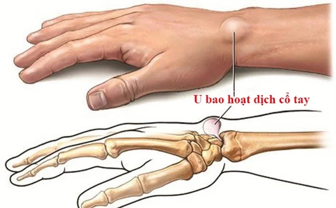 Hình ảnh viêm bao hoạt dịch