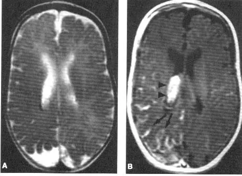 Hình ảnh MRI trong hội chứng Sturge-Weber