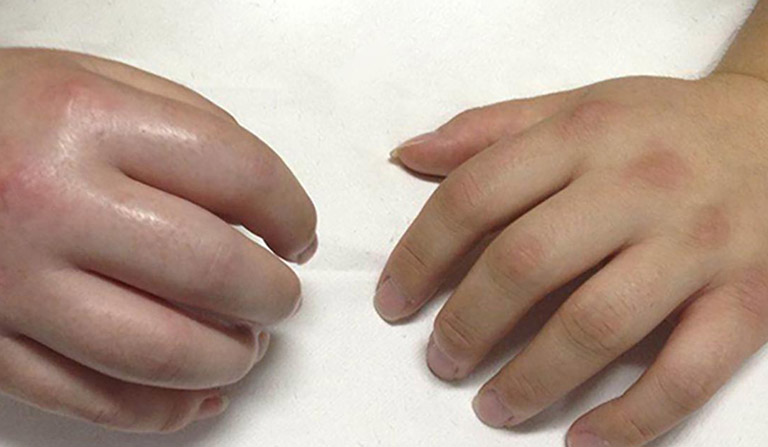 Hội chứng sudeck: hiểu rõ để điều trị hiệu quả