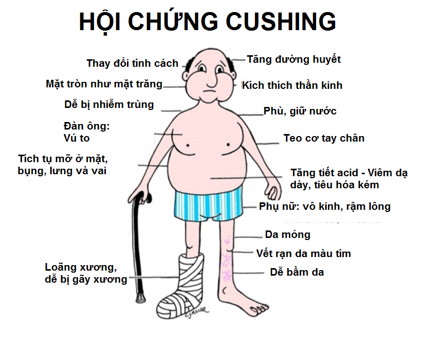 Hội chứng Cushing do lạm dụng thuốc corticoid.