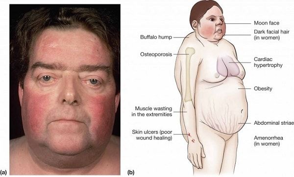Việc lạm dụng các loại thuốc chứa corticoid không theo chỉ định là nguyên nhân hàng đầu gây hội chứng Cushing ngoại sinh