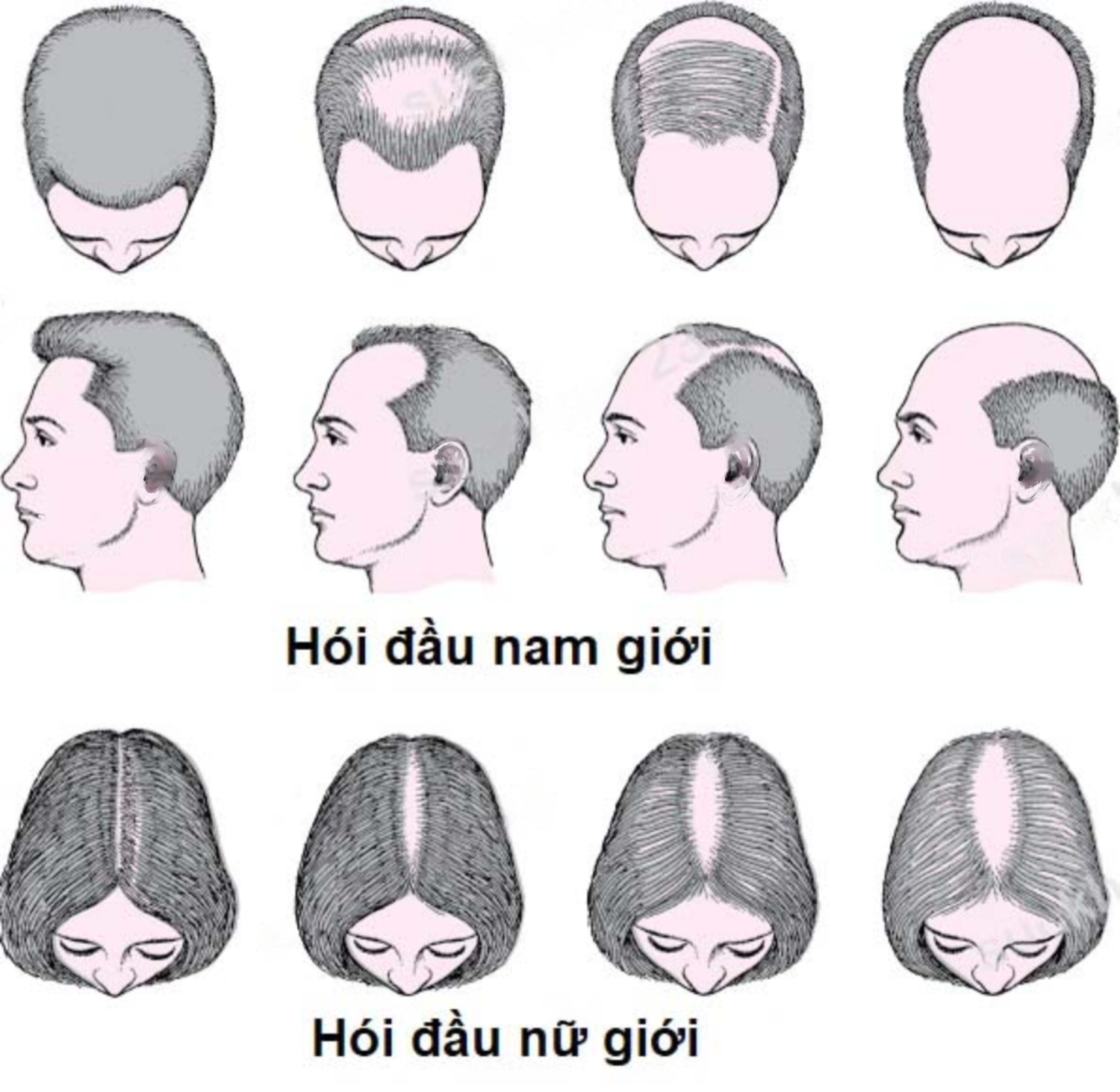 Hói là gì? Những điều cần biết về hói