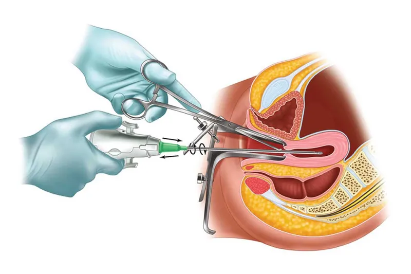 Sau khi thực hiện nạo hút thai trứng, bệnh nhân cần được theo dõi nồng độ hCG định kỳ để phòng ngừa biến chứng ác tính 