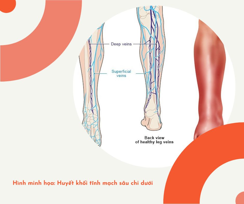 Huyết khối tĩnh mạch sâu chi dưới là gì? Những điều cần biết về huyết ...