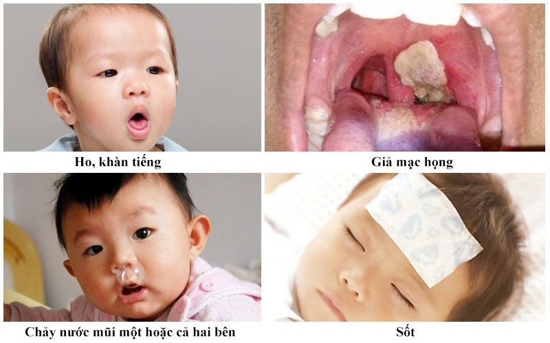 Triệu chứng bệnh bạch hầu ở trẻ em