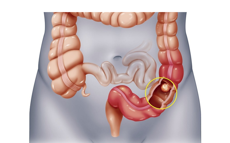 Hình minh họa các kỹ thuật hình ảnh giúp bác sĩ quan sát rõ mức độ xâm lấn của khối u