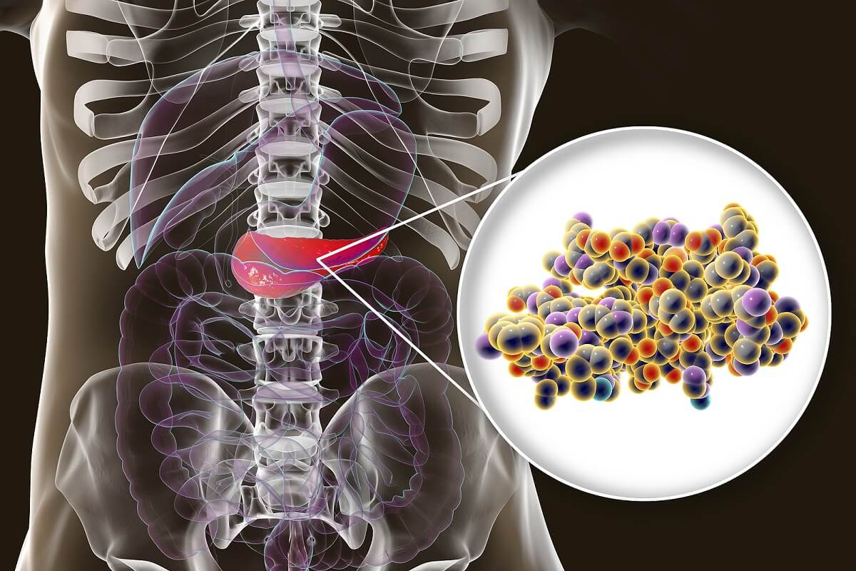 Tổng quan chung u tụy nội tiết Insulinoma