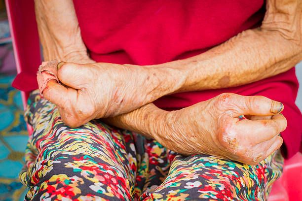 Người bệnh phong cần sự thấu hiểu để tự tin điều trị và hòa nhập xã hội 