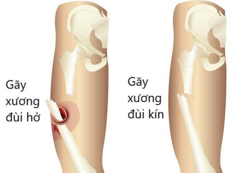 Hình ảnh gãy xương đùi