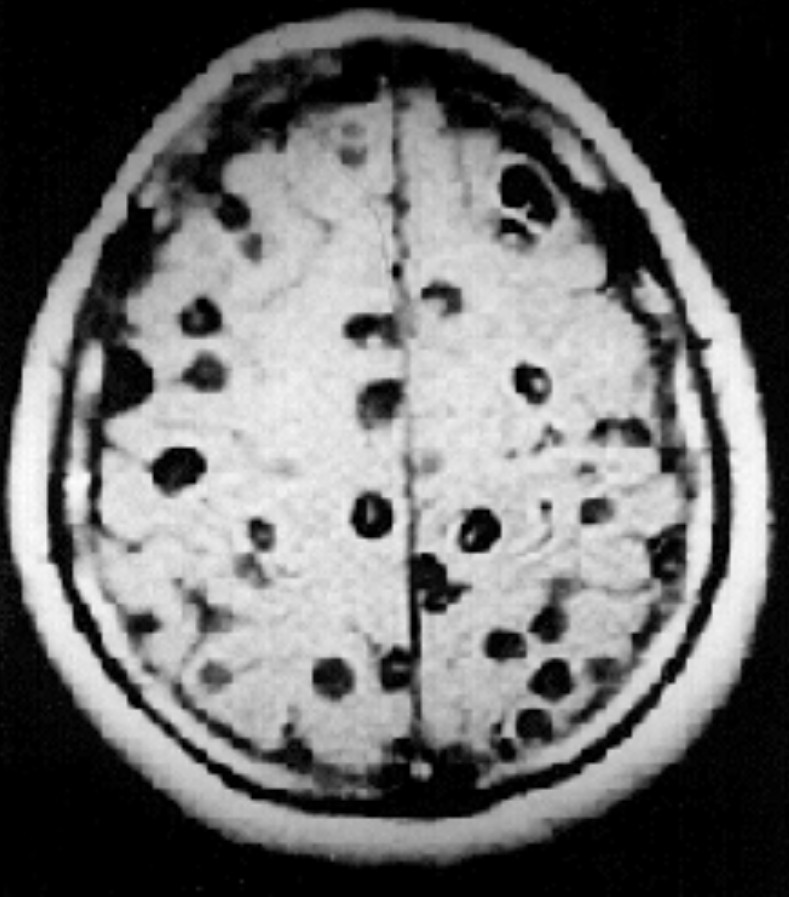 Chẩn đoán ấu trùng sán lợn bằng chụp MRI