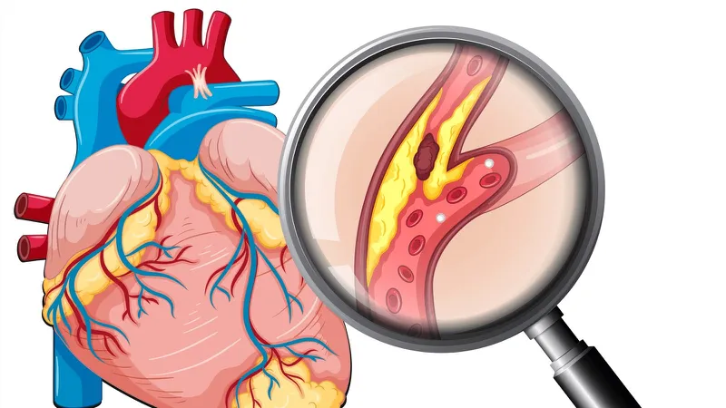 Sơ đồ mô tả tình trạng xơ vữa động mạch gây tắc nghẽn lưu thông máu 