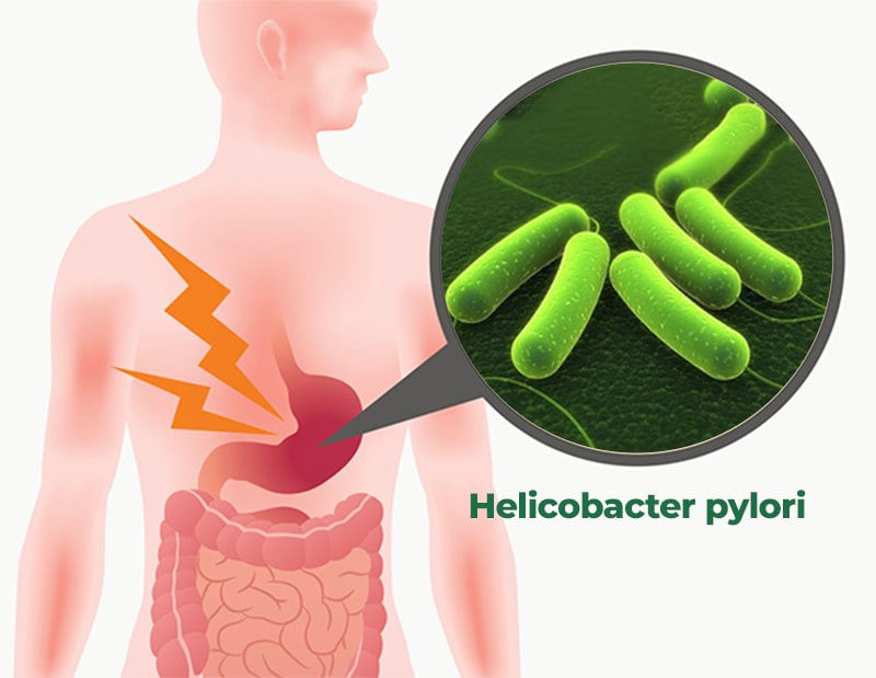 Vi khuẩn H. pylori là một trong các nguyên nhân gây viêm loét và bệnh ung thư dạ dày