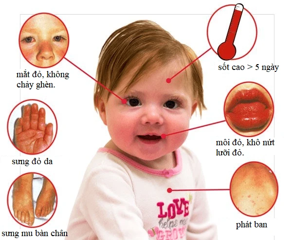 Các triệu chứng điển hình của bệnh Kawasaki