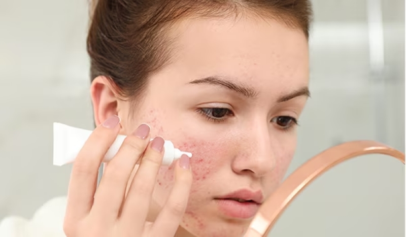 Chấm mụn là gì? Kem chấm mụn có giúp gom cồi mụn hiệu quả