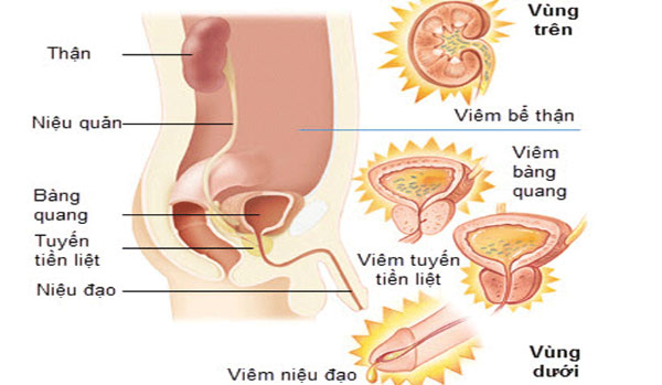 Viêm niệu đạo là tình trạng nhiễm trùng đường tiết niệu