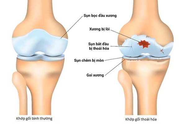 Hình ảnh minh họa khớp khỏa mạnh và khớp thoái hóa