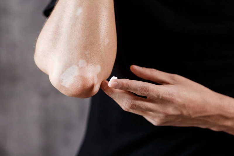 Điều trị đúng cách bằng thuốc kháng nấm có thể chữa khỏi lang ben và ngừa bệnh tái phát