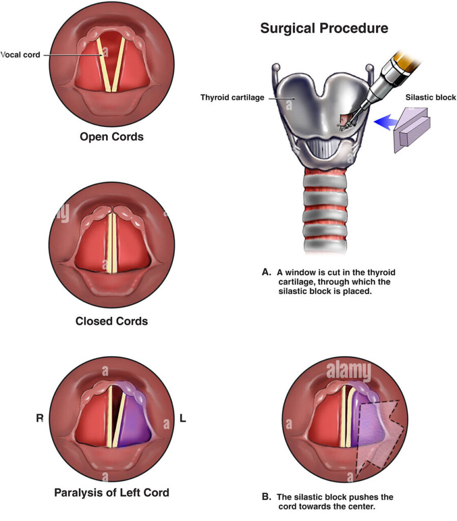 Chẩn đoán liệt dây hồi quy