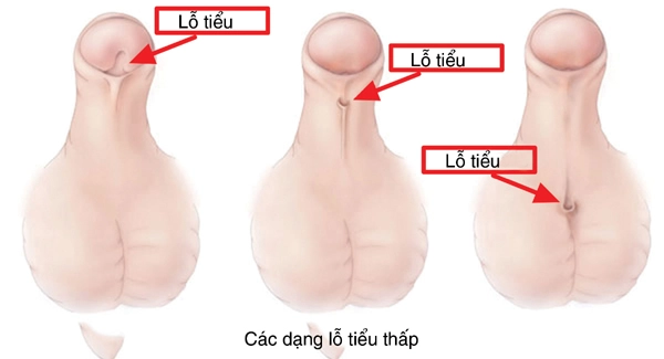 Lỗ tiểu lệch thấp – hypospadias