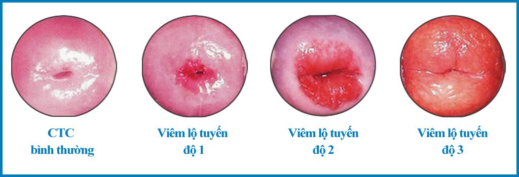 Hình ảnh lâm sàng của 3 cấp độ viêm lộ tuyến tử cung