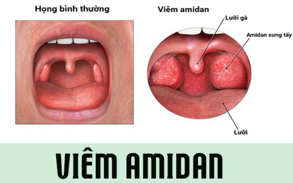 Viêm amidan có thể là nguyên nhân gây loạn cảm họng