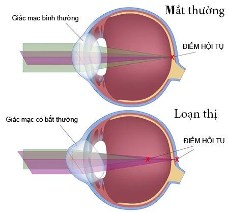 Tật loạn thị là gì?