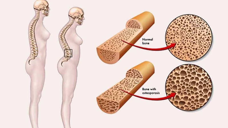 Hormone estrogen ảnh hưởng đến loãng xương sau mãn kinh.