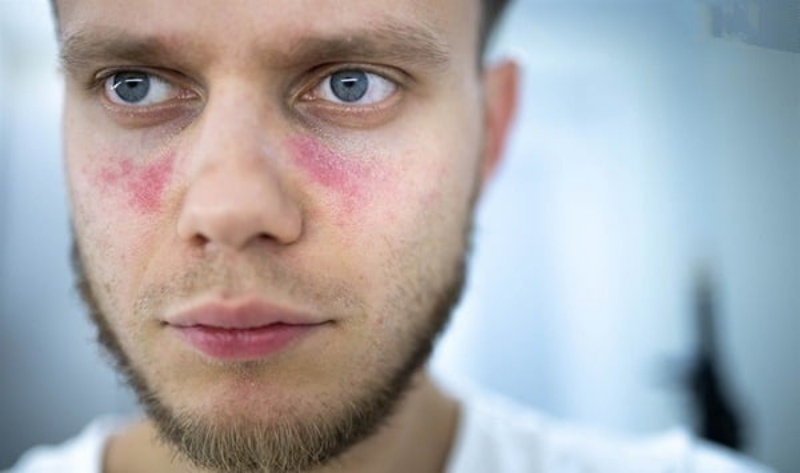 Đối tượng nguy cơ bị Lupus ban đỏ