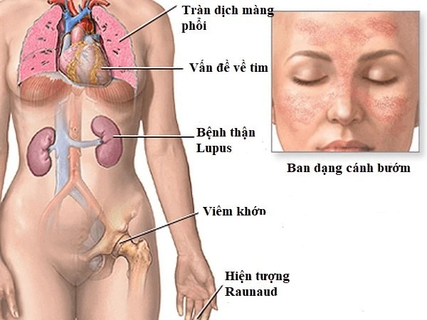 Viêm thận lupus