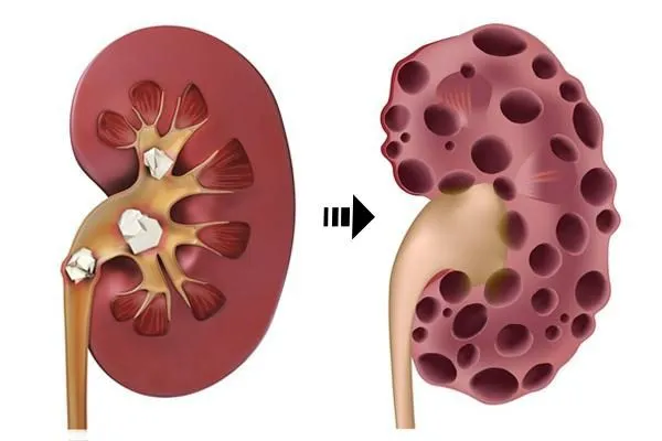                        10% đến 30% bệnh thận lupus  phát triển thành suy thận