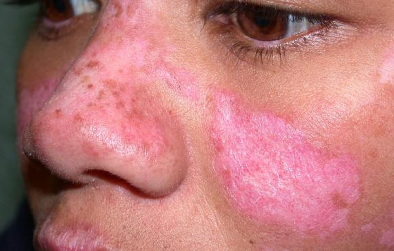 Lupus Ban Đỏ Hình Đĩa: Hiểu Rõ, Điều Trị Hiệu Quả và Cuộc Sống Tích Cực