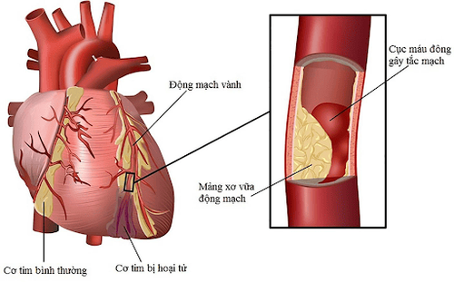 Mỡ máu cao làm tăng nguy cơ mắc các bệnh tim mạch