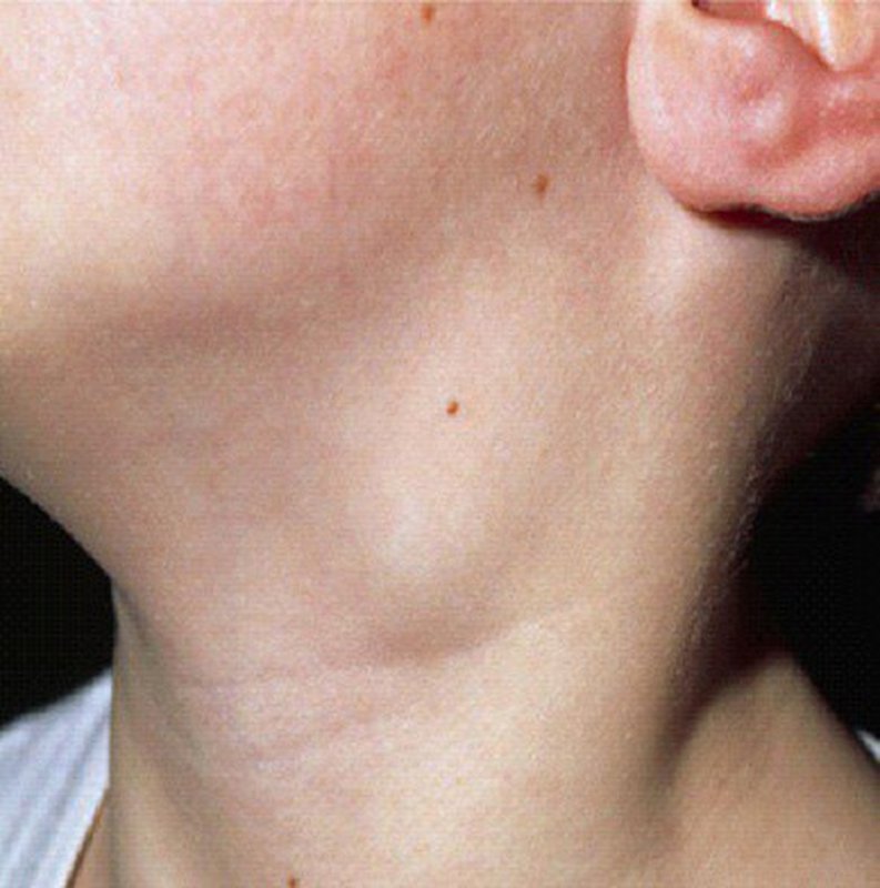 Sưng ở cổ, nách hoặc háng, mệt mỏi kéo dài, sốt là các triệu chứng điển hình ở người bệnh u lympho không Hodgkin