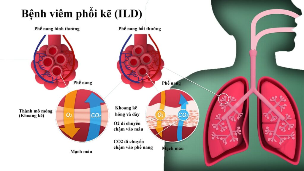 Chẩn đoán viêm phổi kẽ lympho bào