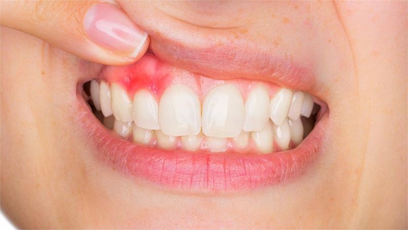 Nướu sưng đỏ và đau khi chạm vào có thể là dấu hiệu của viêm chân răng
