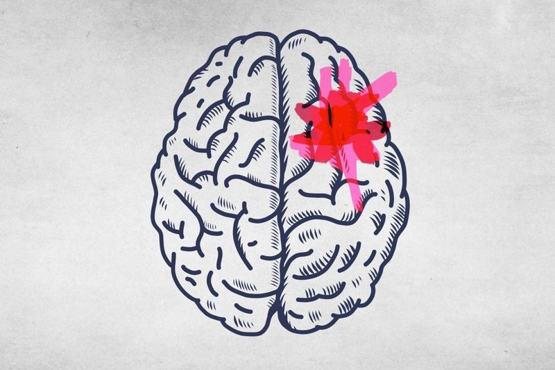 Hình minh họa MRI giúp theo dõi di căn ung thư và lập kế hoạch điều trị