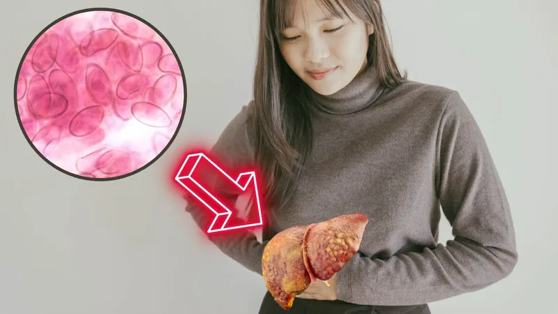 Minh hoạ về sán lá gan ở người bệnh