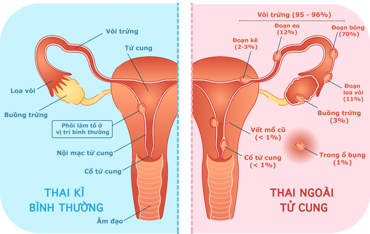 Biểu hiện khi bị mang thai ngoài tử cung?