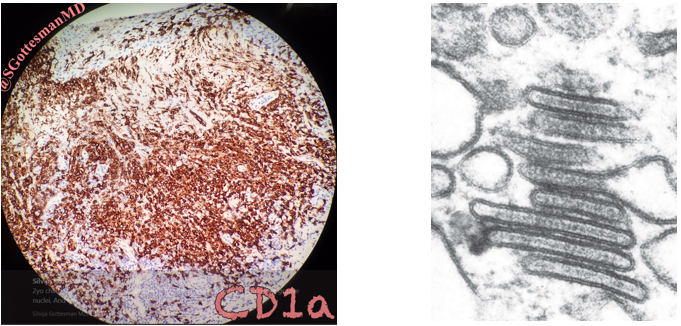 HMMD dương tính với CD1a và KHV điện tử: hạt Birkbeck