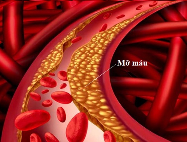 Mỡ máu cao là tình trạng rối loạn lipid trong máu, dẫn đến tăng nồng độ cholesterol xấu (LDL), triglyceride và giảm cholesterol tốt (HDL.