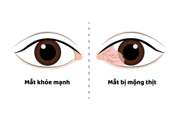 Mắt bị mộng thịt